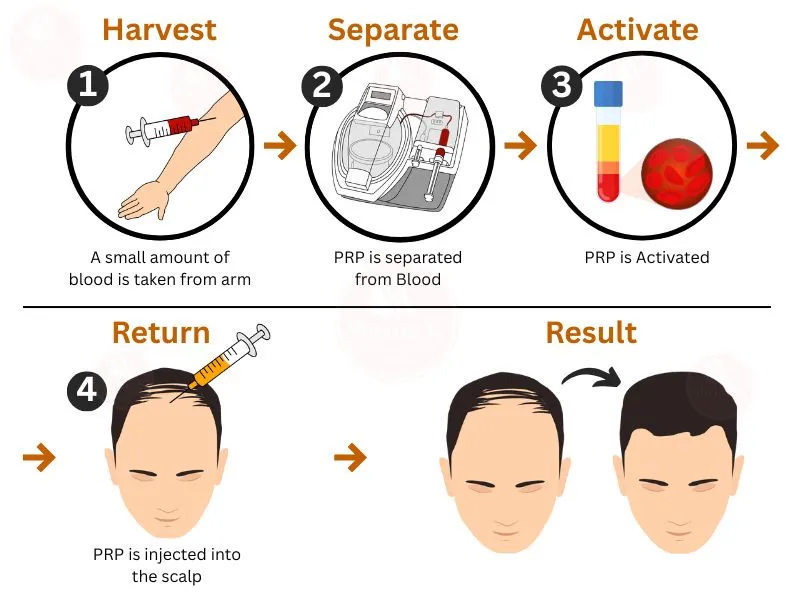 PRP Hair Treatment for hair loss process